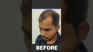 Hair transplant in indore | Amazing Hair transplant result #shorts #viral #hairtransplantinindore