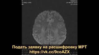 Расшифровка МРТ головного мозга патологий не выявила