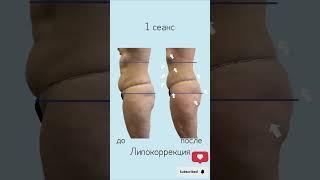 Антицеллюлитный массаж- результат за 1 сеанс #массажтела #антицеллюлитныймассаж #липокоррекция
