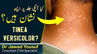 Tinea versicolor skin infection children | treatment | Causes | In Hindi Urdu Healers Online