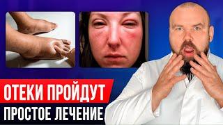 Избавиться от отеков НАВСЕГДА! Как вылечить отеки без лекарств и врачей