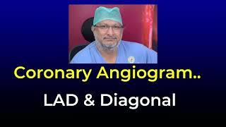 Coronary Angiogram and Left Anterior Descending Artery (LAD): Deep in Epicardial Fat