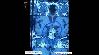 Pituitary Adenoma #pituitary #brainsurgery  #braintumor #braintumour #endoscopicspinesurgery