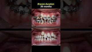 Braces for crowded teeth #braces #orthodontist #dentistry #dentist