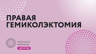 расширенная правосторонняя гемиколэктомия // лапароскопическая гемиколэктомия // right hemicolectomy