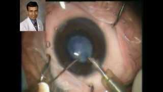 Infantile Cataract & IOL Surgery Dr Suresh Pandey SuVi Eye Institute Kota India