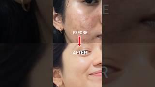 1 PRODUCT Changed ACNE TO CLEAR SKIN JOURNEYWith in 2 month#acne