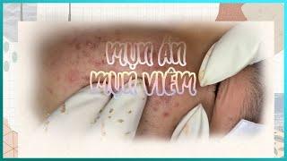 Big Cystic Acne Blackheads Extraction Blackheads & Milia, Whiteheads Removal Pimple Popping