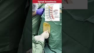 How spinal Anesthesia procedure is performed in Surgery #doctor #mbbs #neet #medical #anesthesia