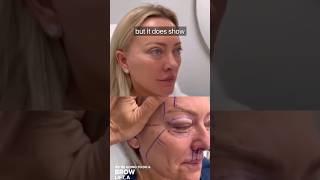 INCREDIBLE Facelift Results | Surgeon Reacts