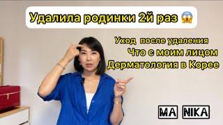 2 часть / Повторное удаление родинок / Что с моим лицом / Жалею или нет