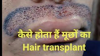 moustache hair transplant indore ujjain dhar khandwa khargone dewas ratlam mandsaur jhabua rewa mhow