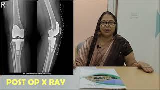 Patient review after 1 month of Total knee replacement surgery /TKR done at  Welton Hospital Jaipur