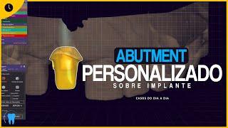 EXOCAD : Abutment Personalizado Sobre Implante