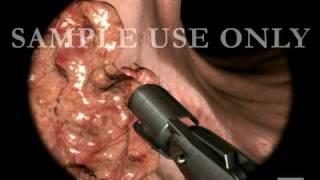 Colon Biopsy