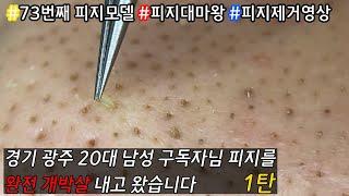 피지 직접 뽑아드렸습니다 _ 피지제거 블랙헤드제거 피지뽑기 _ 경기 광주시에 사는 20대 남자구독자님의 쫀쫀한 피지 정복 프로젝트 1탄