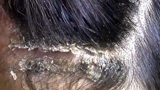 Dandruff scratching removal on head using black combing#189