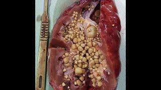 how to clean the kidneys from stones with the help of flax seeds