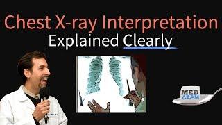 Chest X-Ray Interpretation Explained Clearly - How to read a CXR