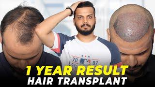 Hair Transplant in Chandigarh | Best Results & Cost of Hair Transplant in Chandigarh