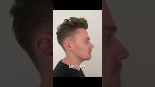 Result after a Hair Transplant | Elithair #shorts