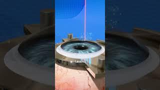 How Laser Eye Surgery Actually Works! ️‍️