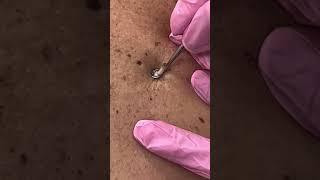 Blackhead removal