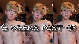 6 WEEKS POST OP TOP SURGERY WITH MILES BERRY (FTM TRANSGENDER) | NOAHFINNCE