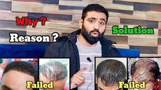 Transplanted Hairfall Just After 7 Month | Reason & Permanent Solution of Hairfall