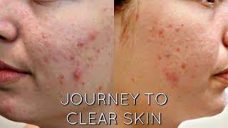 ACNE CHEMICAL PEEL - JOURNEY TO CLEAR SKIN