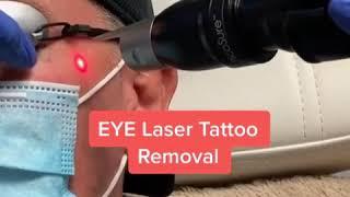 Taking off EYE Tattoo