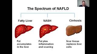 FATTY LIVER DISEASE: SIMPLE CAUSE, SIMPLE CURE