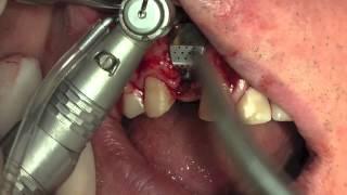 i Gen membrane with AnyRidge implant