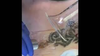 Dr. Paul M. Friedman Performing Laser Tattoo Removal Using Define PDF Patch