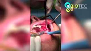 Biotec dental implant bone integration