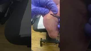 Watch a Podiatrist Remove Corn and Calluses with Ergonx and Docpods for Healthy and Pain-Free Feet