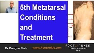 5th Metatarsal Conditions | Seattle Podiatrist