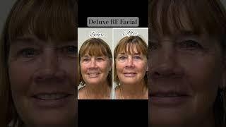 Discover the magic of our Deluxe RF Facial! #RFTherapy #AntiAging #SkincareTips #FacialTreatment
