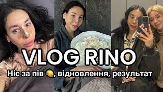 VLOG РИНОПЛАСТИКА Єви за пів ляма: про операцію і відновлення | Fashion week в Києві | мама у гостях