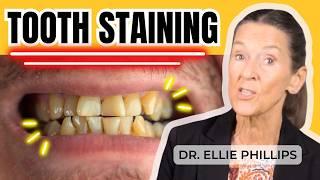 Why You Have Tooth Staining