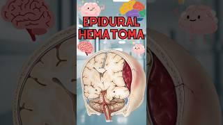 Epidural hematoma #epidural #blood #headtrauma #medical #facts #videos #fyp #fy #fypシ゚ #brain