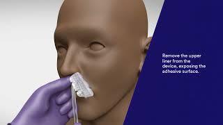 3M™ Nasogastric Securement Device Application and Removal Video