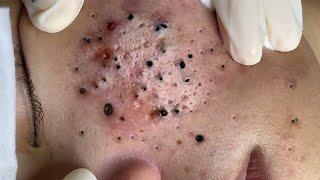 Big Cystic Acne Blackheads Extraction Blackheads & Milia, Whiteheads Removal Pimple Popping # 1643