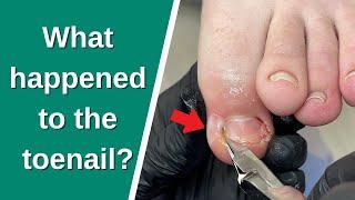 Extreme Ingrown Toenail Relief – Full Podiatry Procedure
