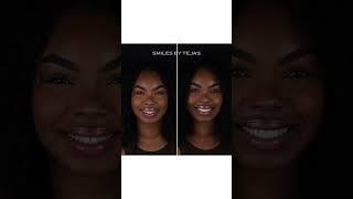 Before and after no prep veneers