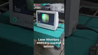 RIRS#laser lithotripsy#no scar #no incision#dr vinish urologist