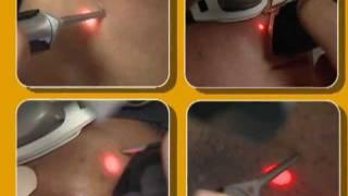 Laser Hair Removal video by Cynosure