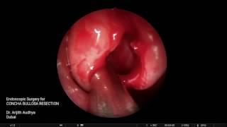 Concha Bullosa Resection Surgery