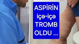 aspirin tromb flotasiya tromboflebit tromboz flebotromboz varikoz damar xesteliyinin fesadlari IDPM