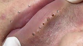 Relaxing Popping Video Pimple popping black head remove Satisfaction With Popping